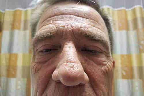 EYELID LIFT Before and After Results