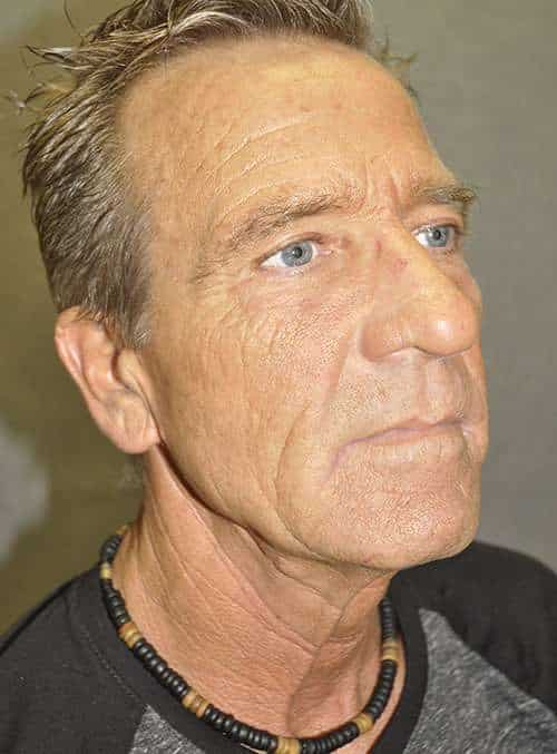 Facelift