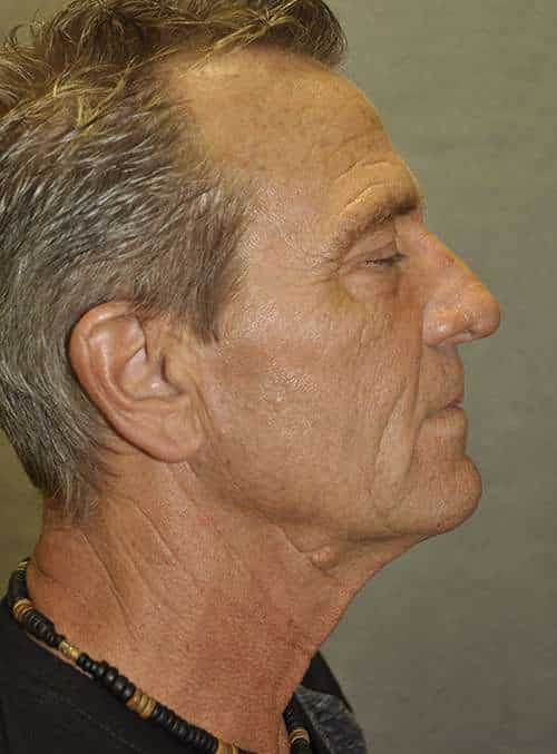 Facelift