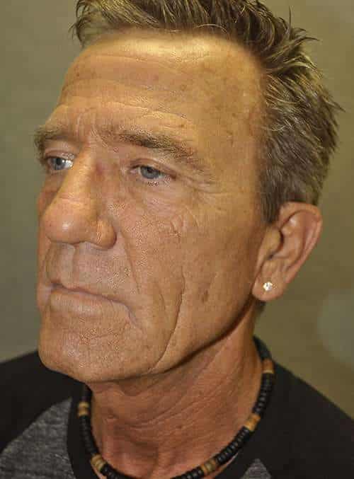 Facelift