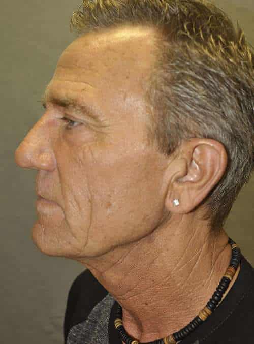 Facelift