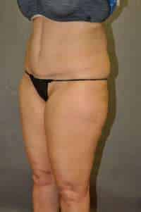 Abdominoplasty