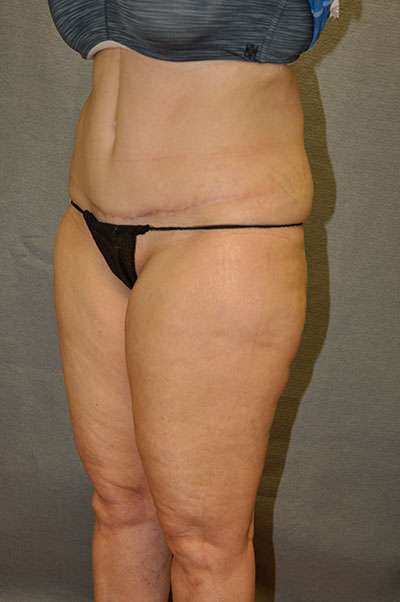 Abdominoplasty