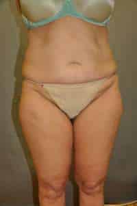 Abdominoplasty