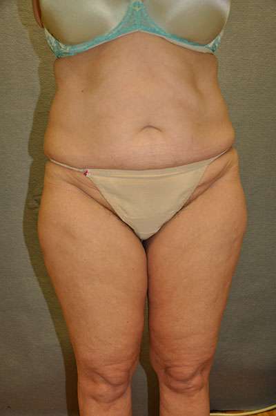Abdominoplasty