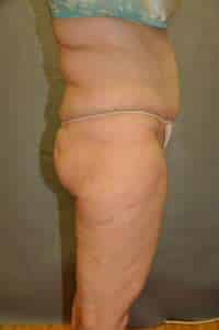 Abdominoplasty