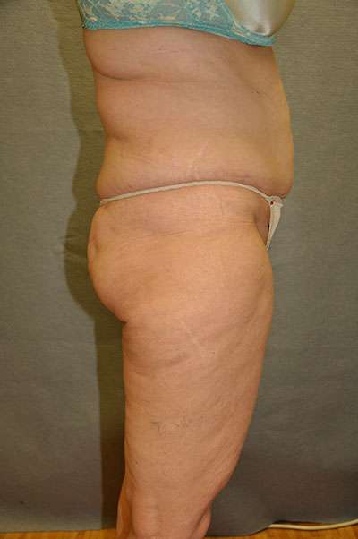 Abdominoplasty