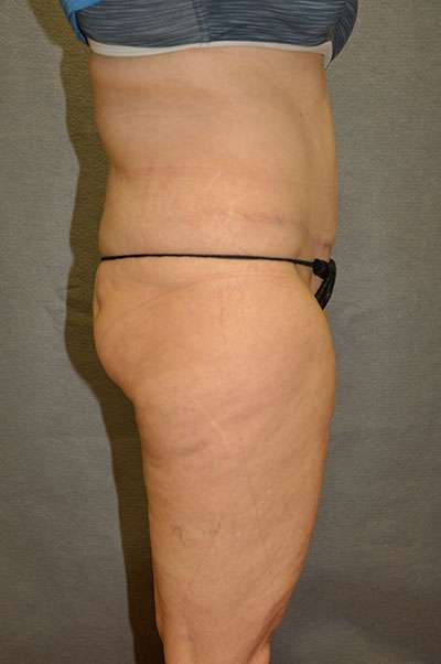 Abdominoplasty