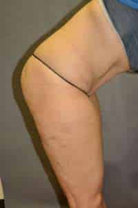 Abdominoplasty