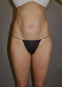 Abdominoplasty