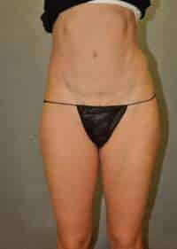 Abdominoplasty
