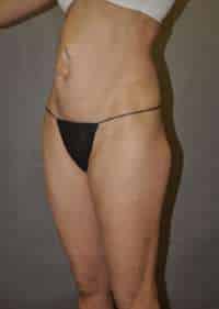 Abdominoplasty