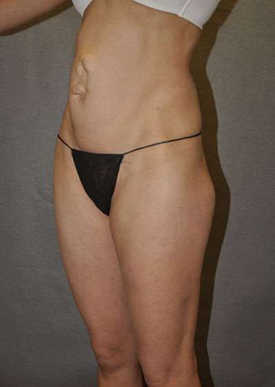 Abdominoplasty