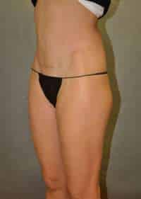 Abdominoplasty