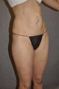 Abdominoplasty