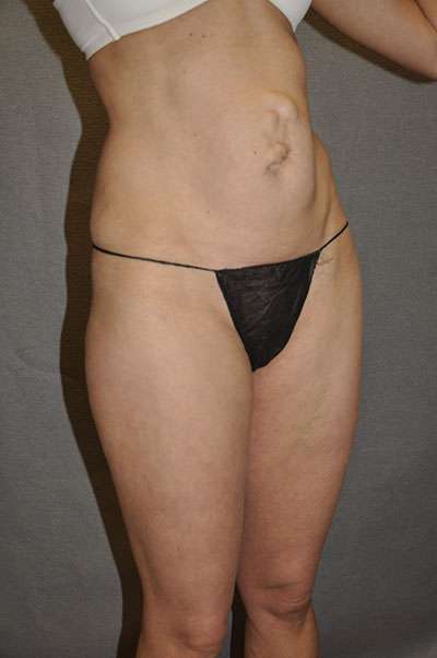 Abdominoplasty