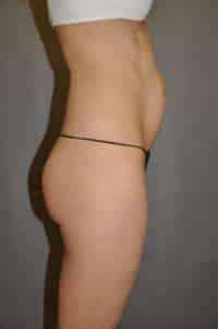 Abdominoplasty
