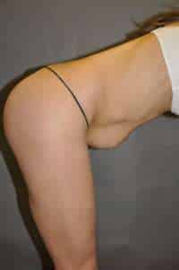 Abdominoplasty