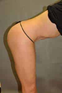 Abdominoplasty