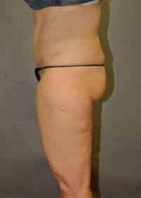 Abdominoplasty