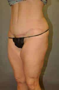 Abdominoplasty