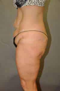 Abdominoplasty