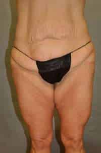 Abdominoplasty