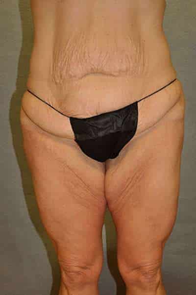 Abdominoplasty