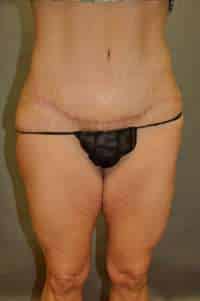 Abdominoplasty