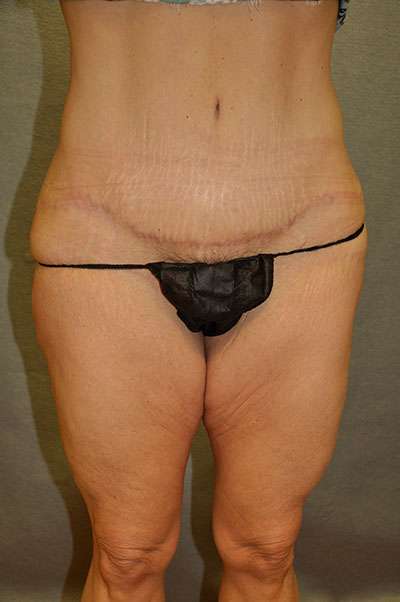 Abdominoplasty