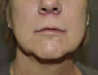 Lip Lift
