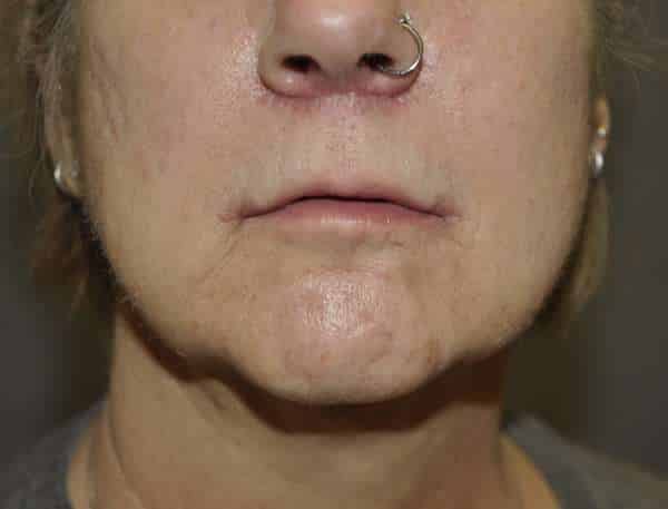 Lip Lift