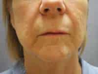 Lip Lift