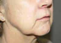 Lip Lift