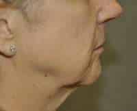 Lip Lift