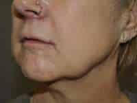 Lip Lift