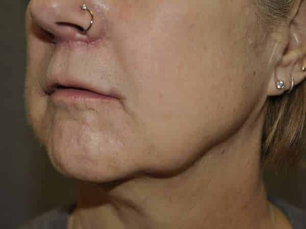 Lip Lift