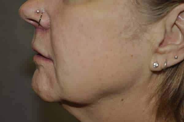 Lip Lift