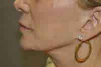 Lip Lift