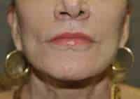 Lip Lift