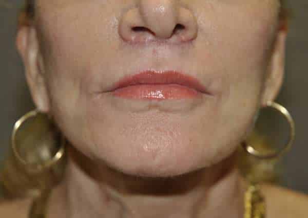 Lip Lift