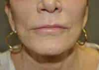 Lip Lift