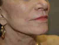 Lip Lift