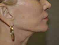 Lip Lift
