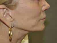Lip Lift