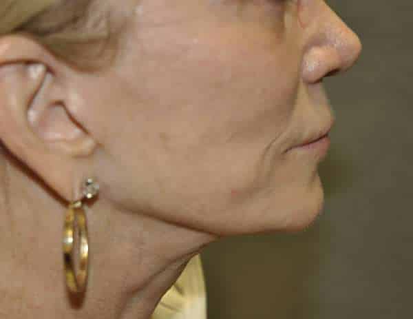 Lip Lift
