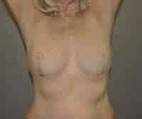 Breast Lift