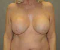 Breast Lift