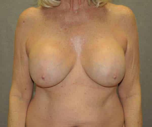 Breast Lift