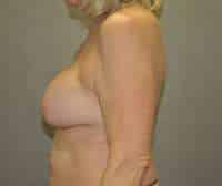 Breast Lift